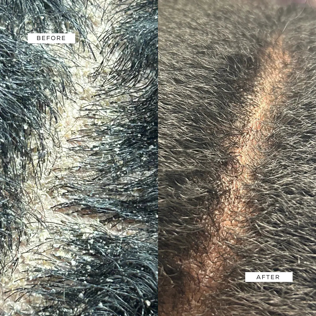 Crown Renewal Scalp & Growth Duo Crown Renewal