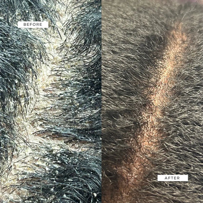 Crown Renewal Scalp & Growth Duo Crown Renewal